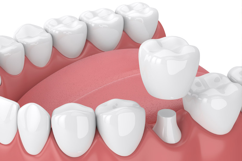 Dental Crowns in Houston