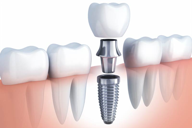 Implants Dentist in Houston