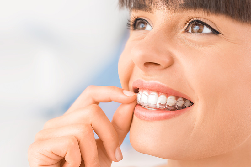 Clear Aligner Treatment in Houston