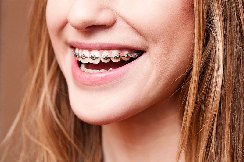 Orthodontics in Houston