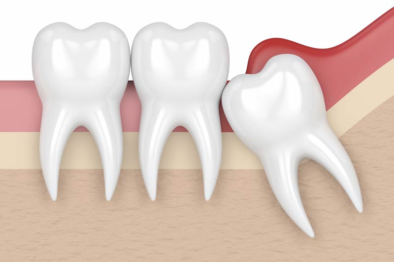Wisdom Tooth Removal in Houston